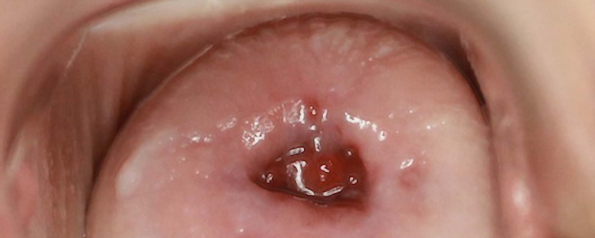 'Peek at Your Cervix'