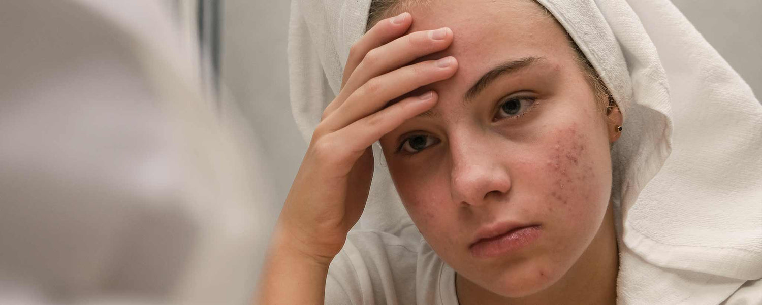 A female troubled by facial acne.