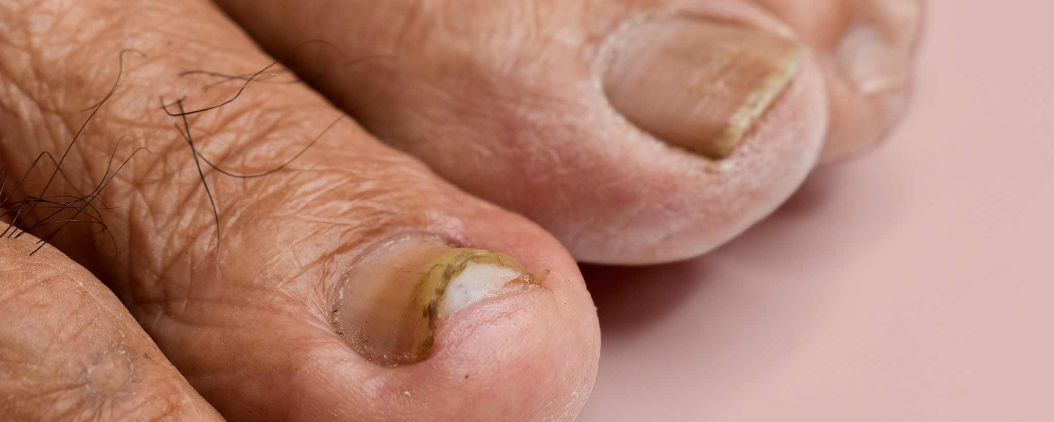 'Toenail Fungus Onychomycosis'