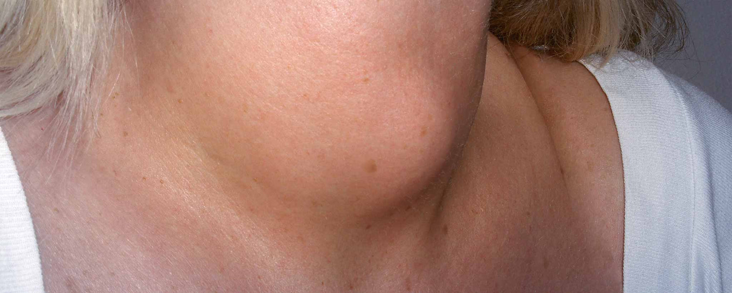 Can hereditary obesity be reversed?