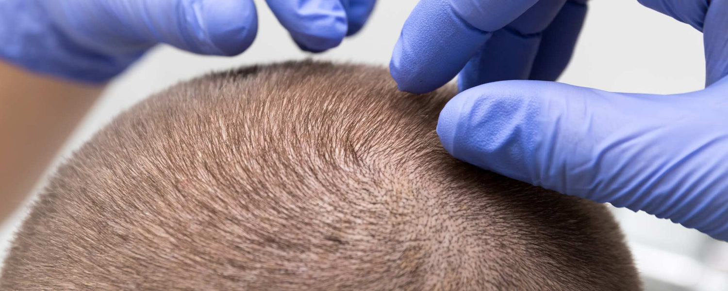 Microblading Your Scalp