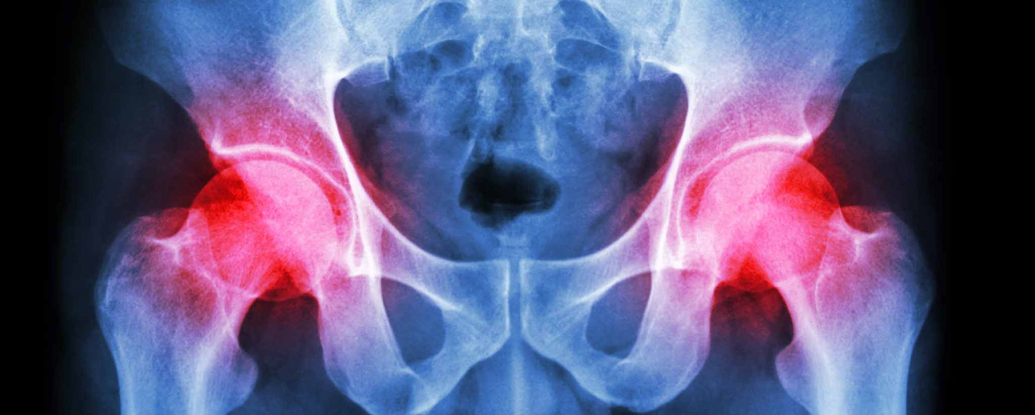 Hip pain x-ray