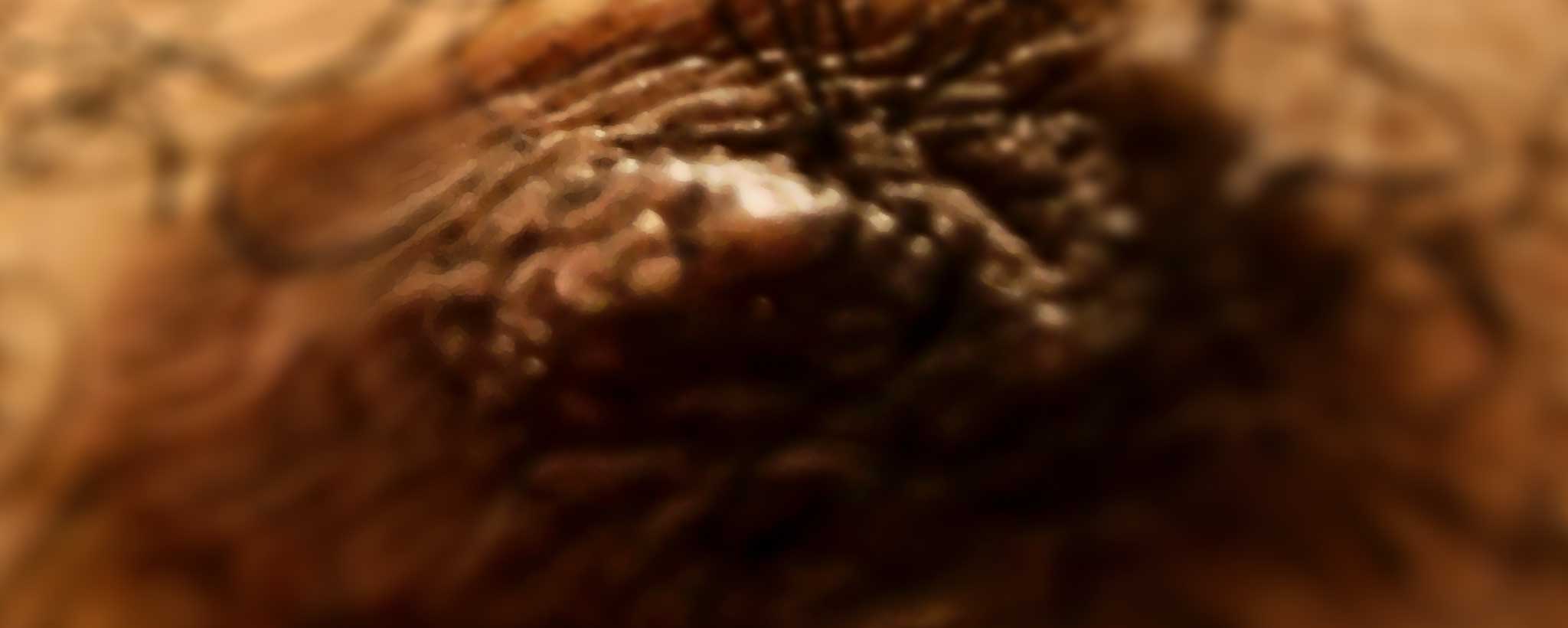 'Clinical Distinctions of Male vs Female Nipples'