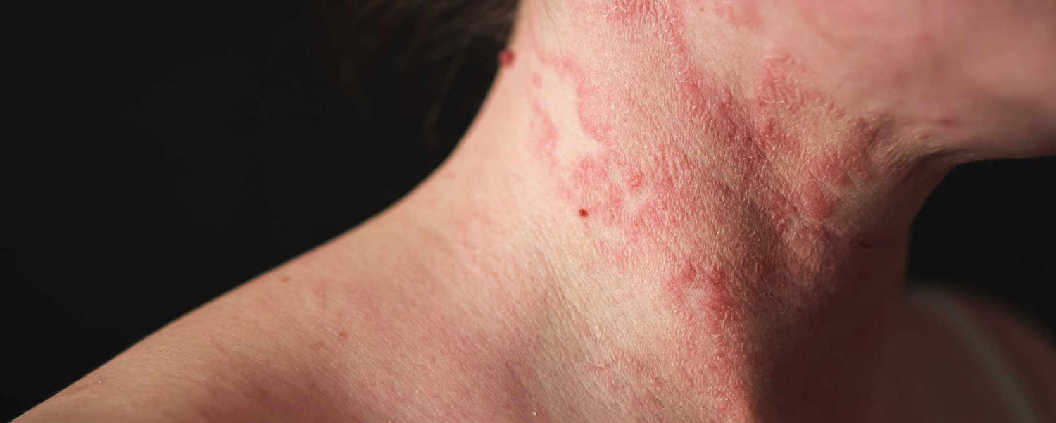 Food Allergies Interfere With Skincare