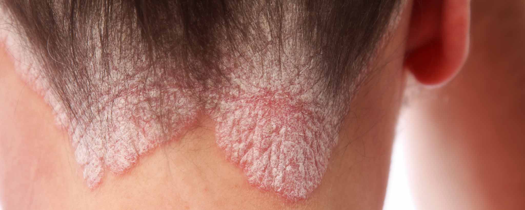 'Get Scalp Psoriasis Under Control'