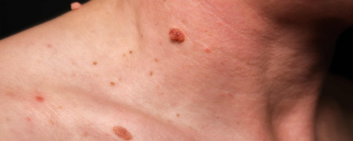 Warts on man's neck