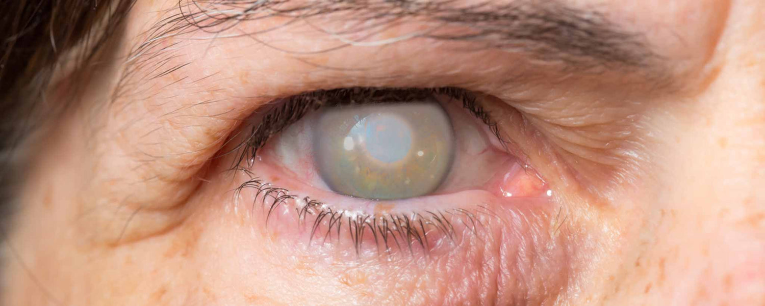 Close-up of a person's eye with a visible opaque cataract.