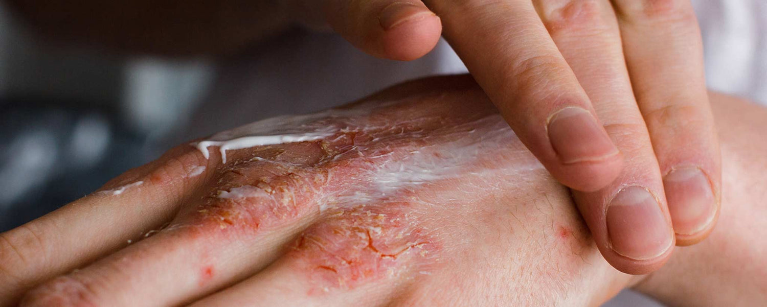 Hard to Feel Scleroderma