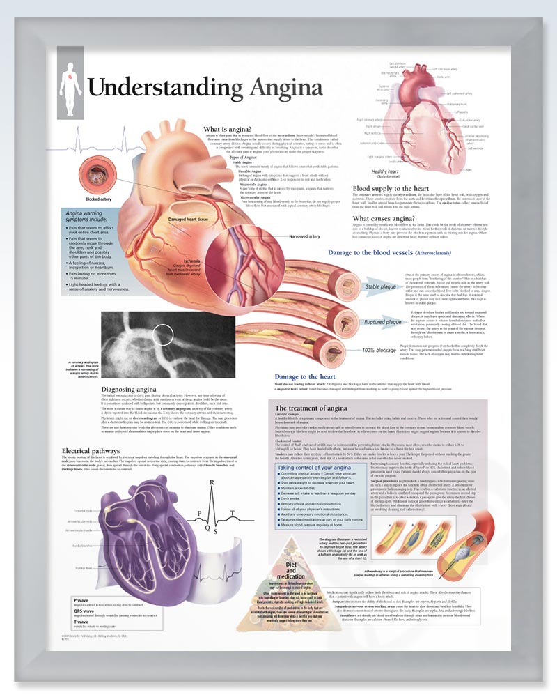 Understanding Angina Chart 22x28