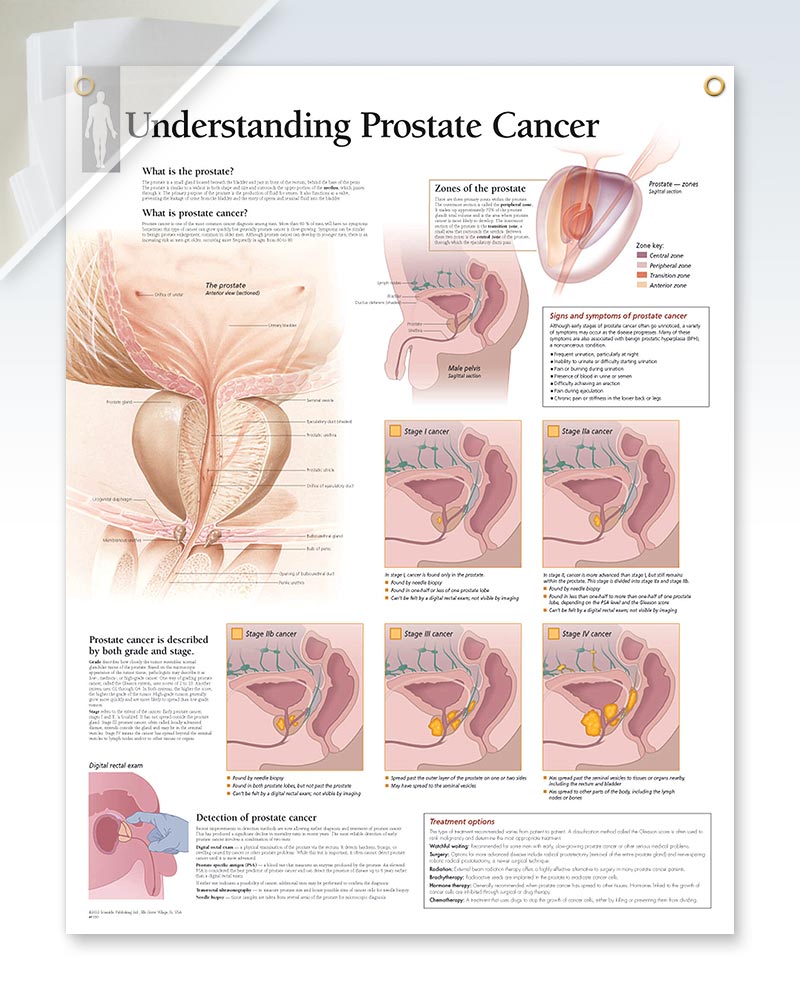 Understanding Prostate Cancer Chart (d) 22x28