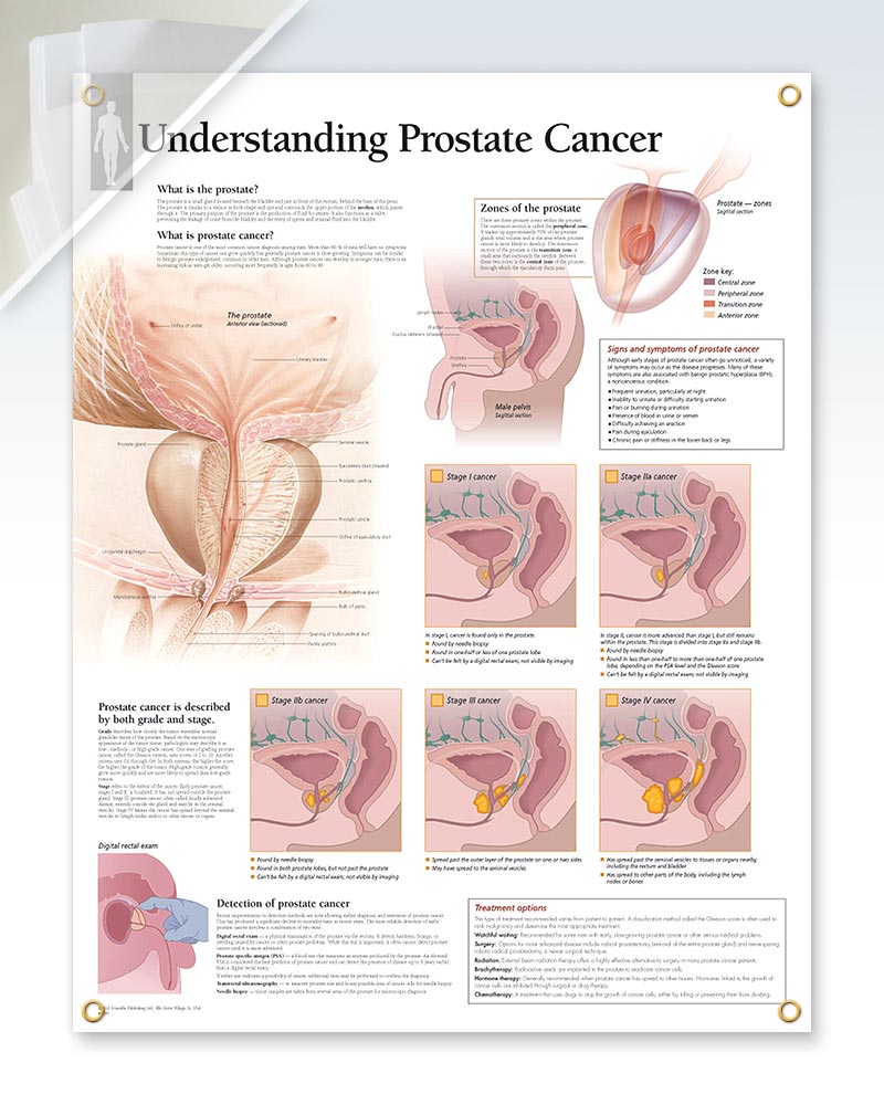 Understanding Prostate Cancer Chart (d) 22x28