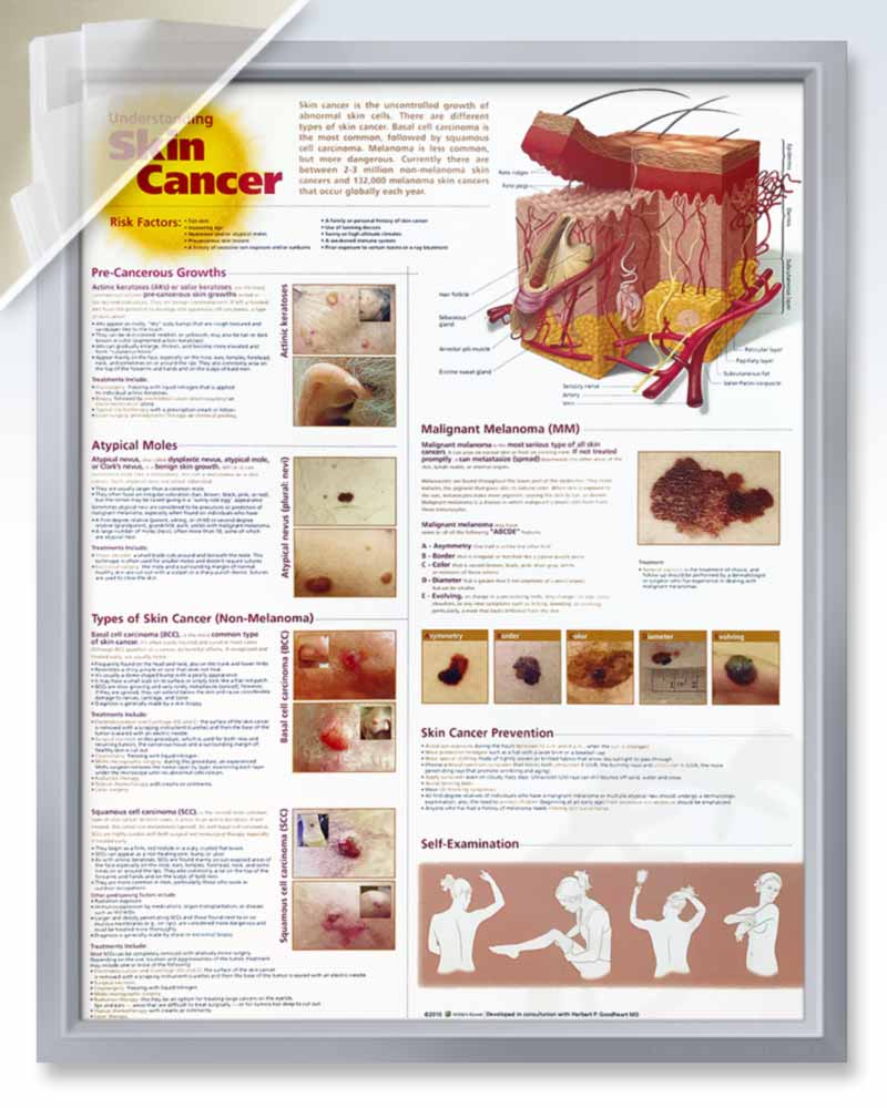 Understanding Skin Cancer Chart (d) 20x26