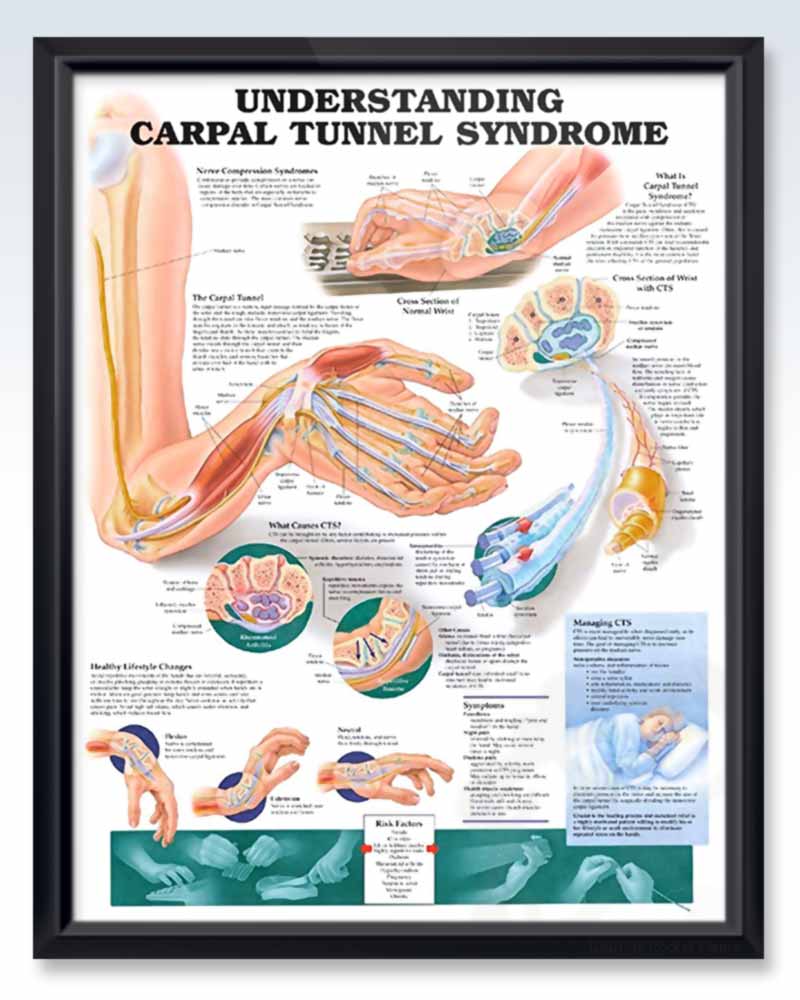 Understanding Carpal Tunnel Syndrome Chart – MEDELCO