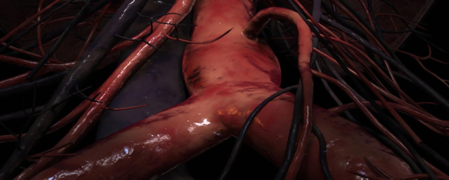 Agonizing Abdominal Aortic Aneurysm