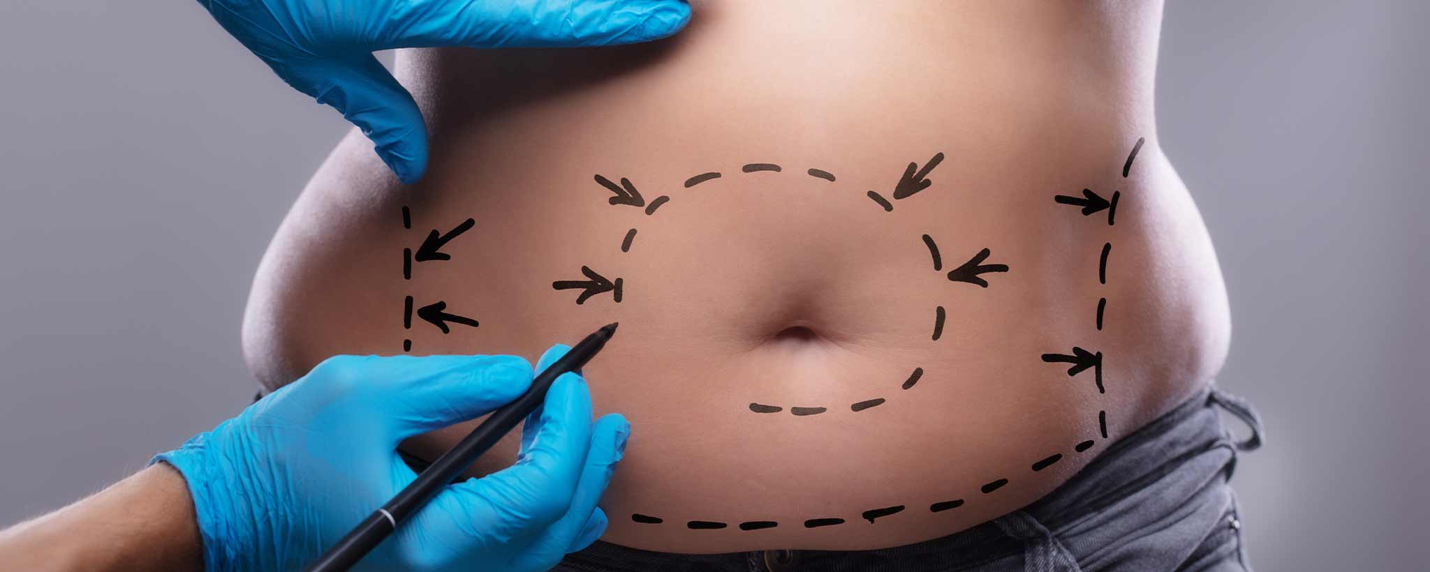 'Female abdominoplasty belly'