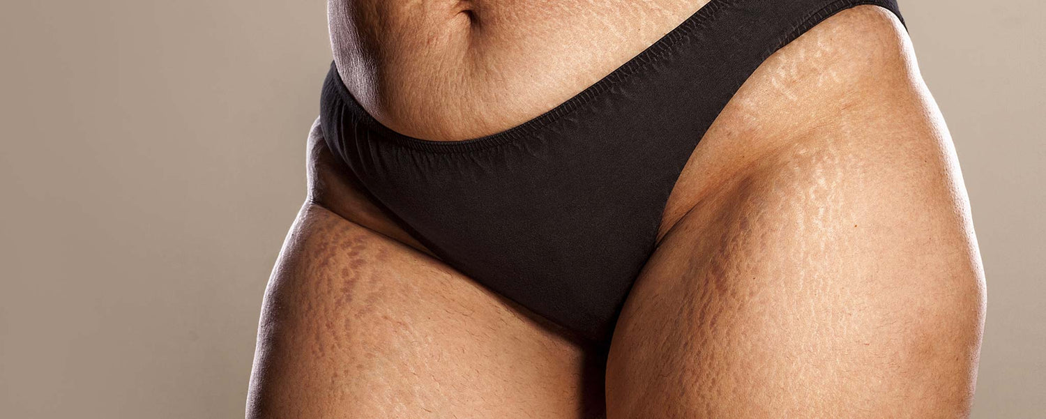 Most Reliable Cellulite and Stretch Mark Treatments