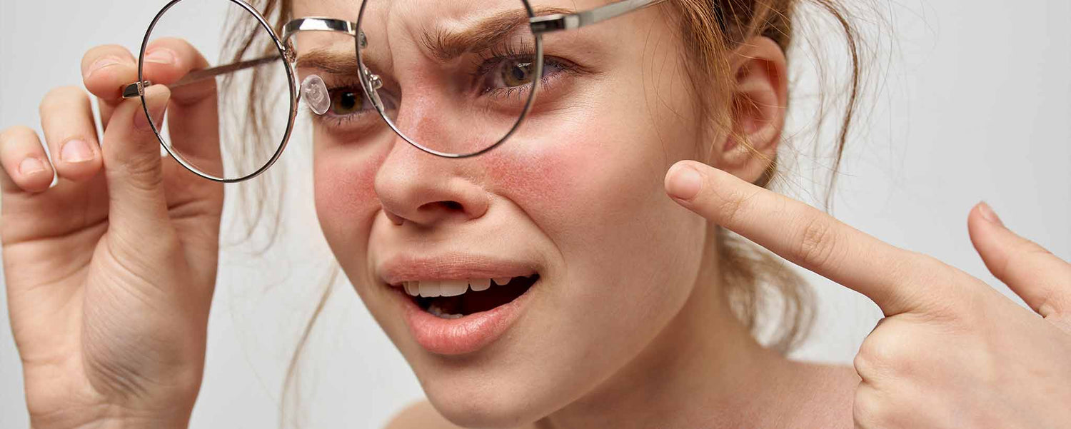 Female lupus facial blemishes