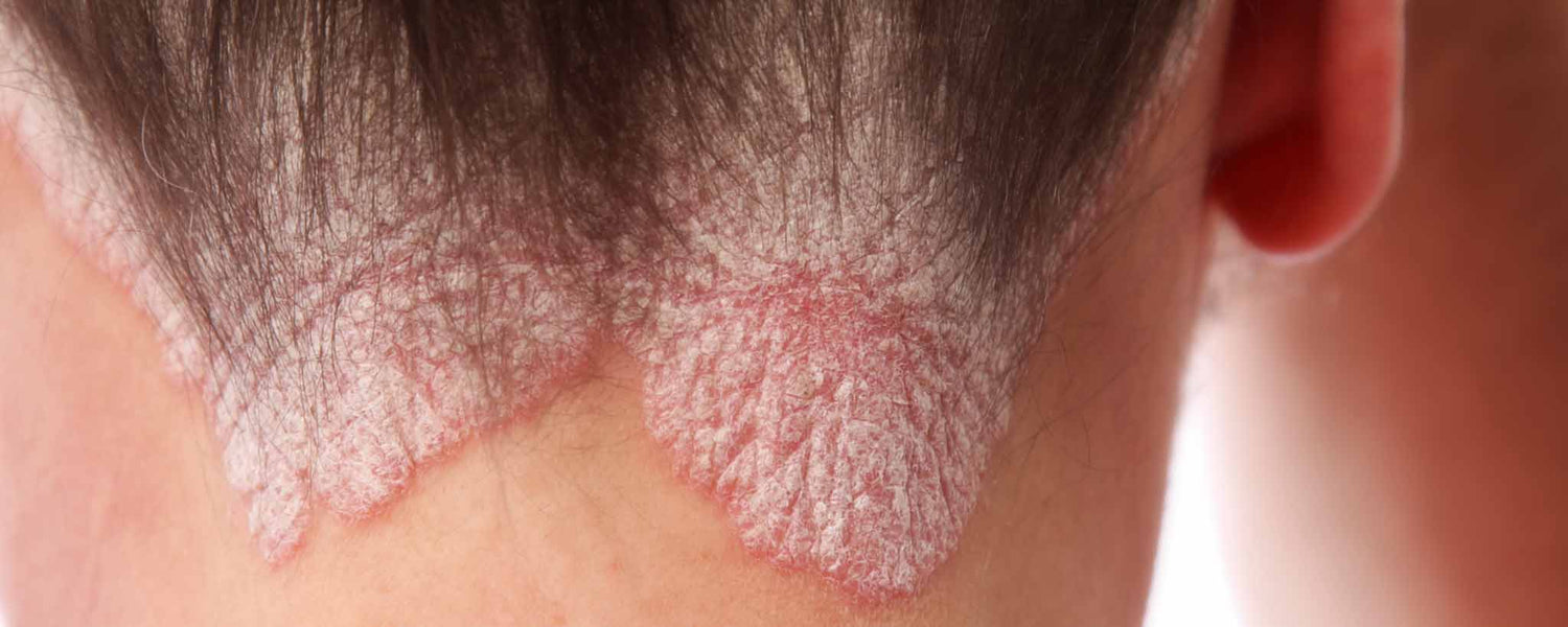 Get Scalp Psoriasis Under Control