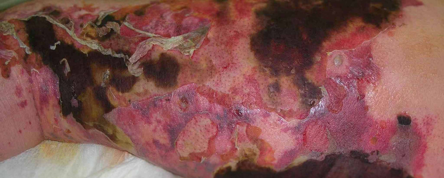 Necrotizing Fasciitis