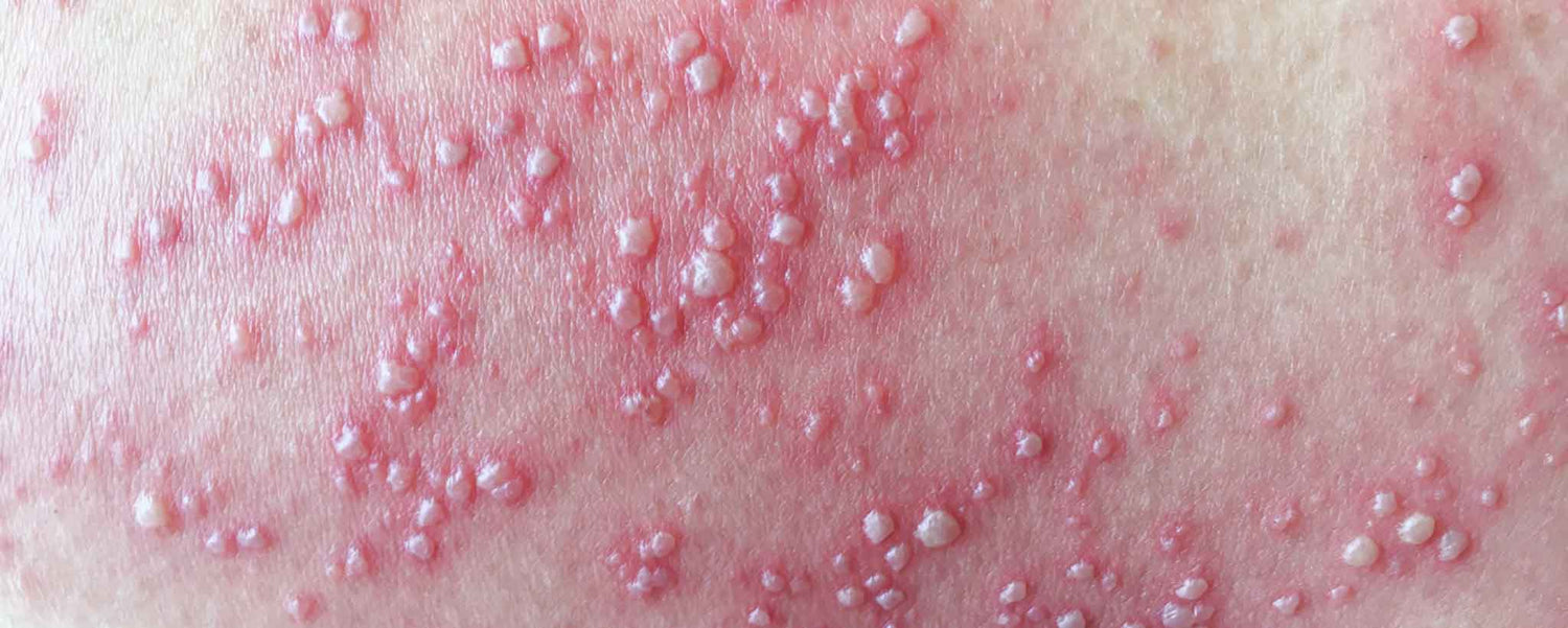 Are You Too Young For Shingles?
