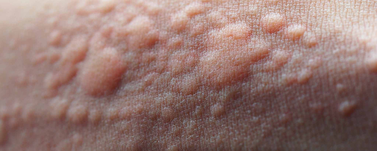 Skin Eruptions Signal Underlying Disorders