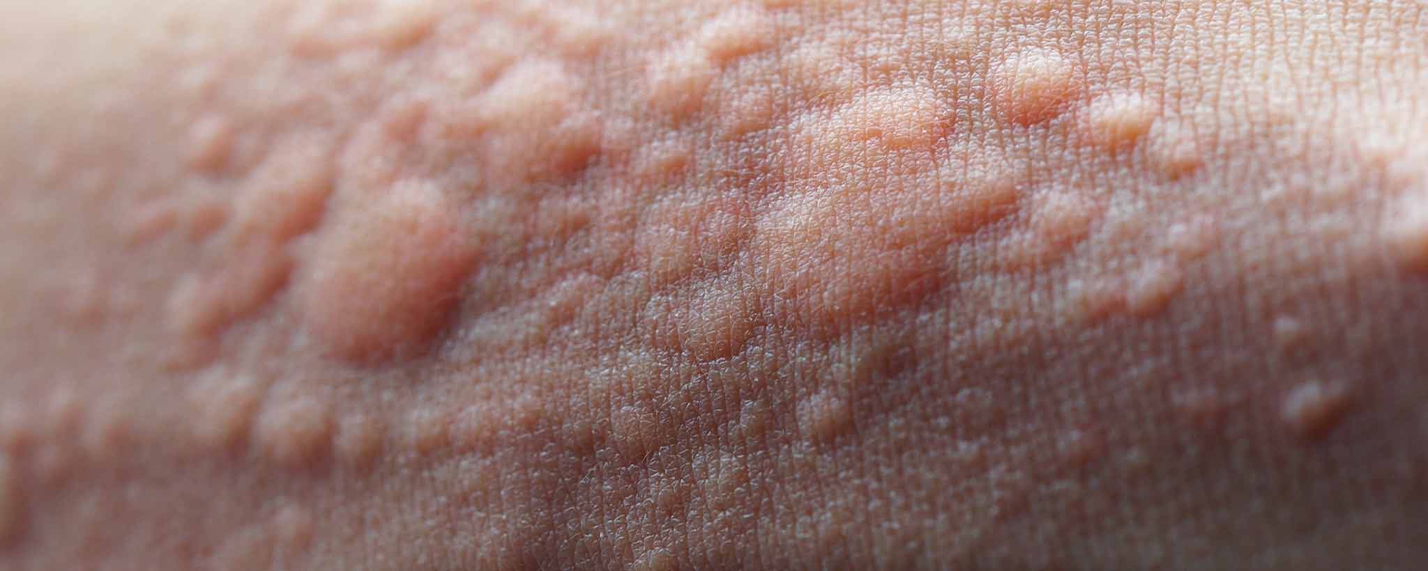 'Skin Eruptions Signal Underlying Disorders'