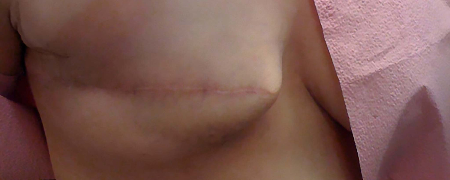 Who’s a Candidate for Skin-Sparing Mastectomy?