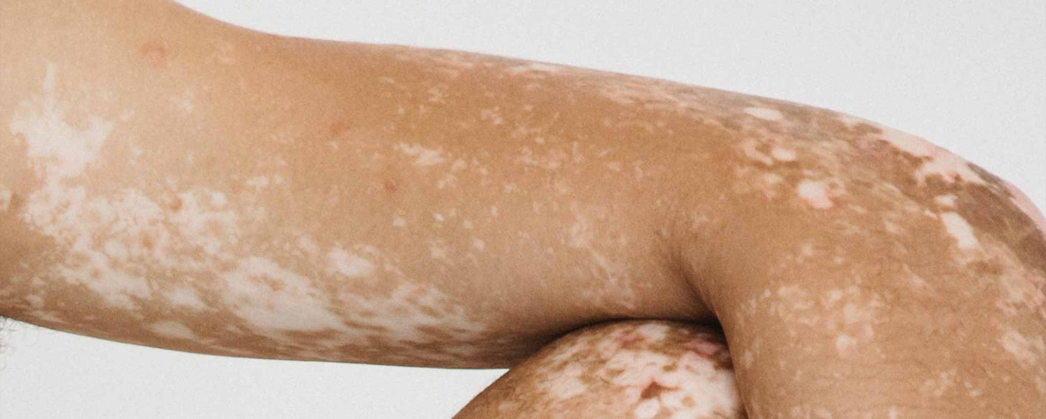 Vitiligo Arm