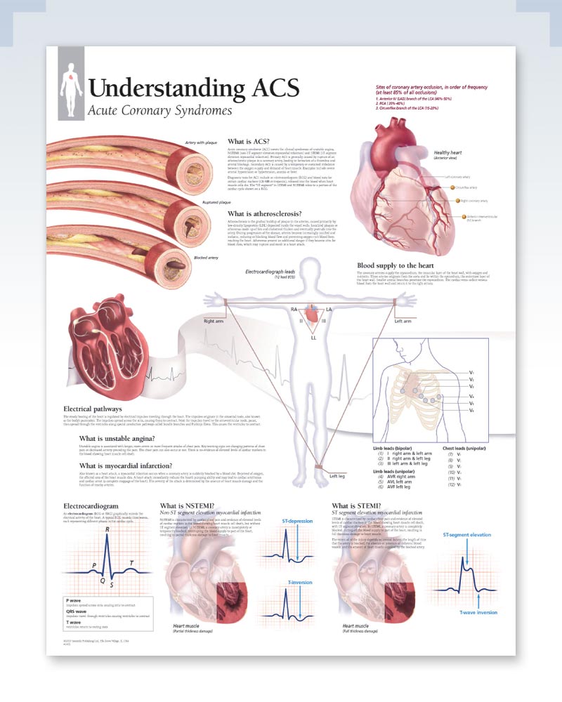 Acute Coronary Syndrome Exam-Room Anatomy Poster | ClinicalPosters