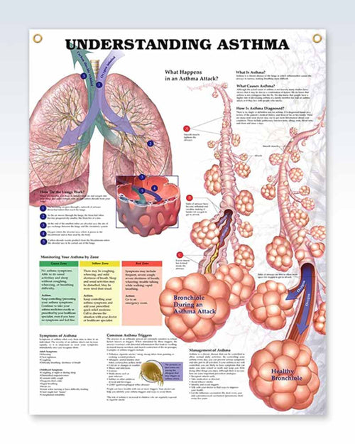 Laminated Asthma Human Anatomy Posters | ClinicalPosters