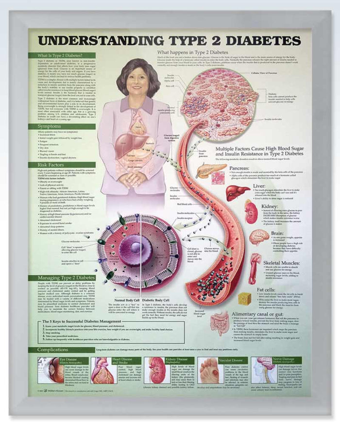Type 2 Diabetes Exam-Room Human Anatomy Posters | ClinicalPosters