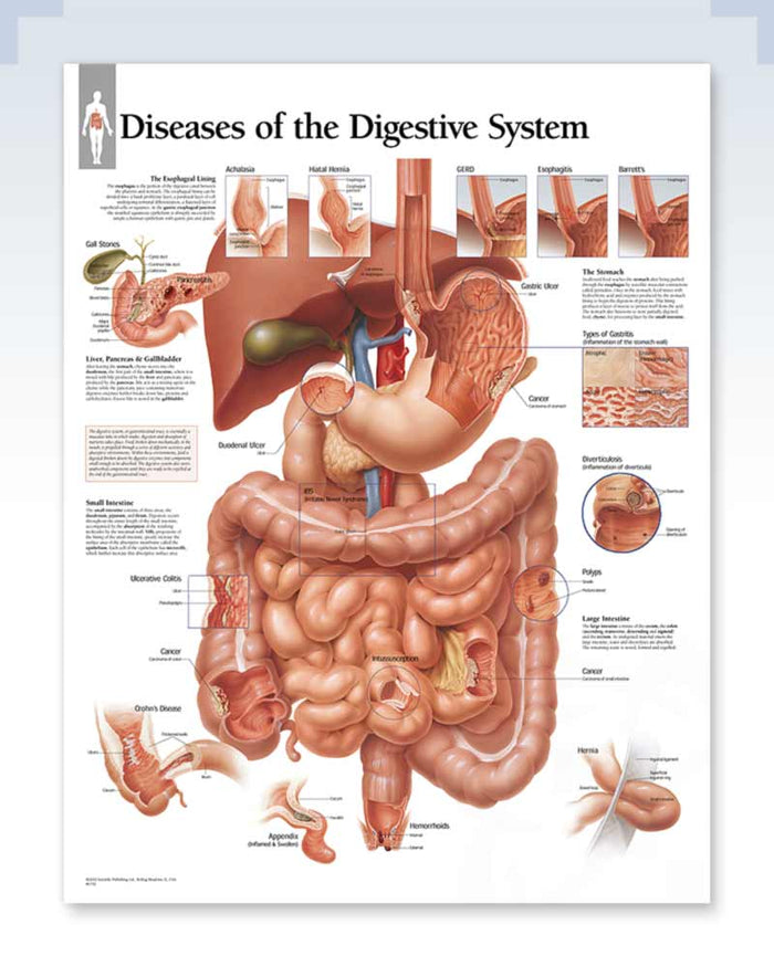 Digestive System Disease Anatomy Posters | ClinicalPosters