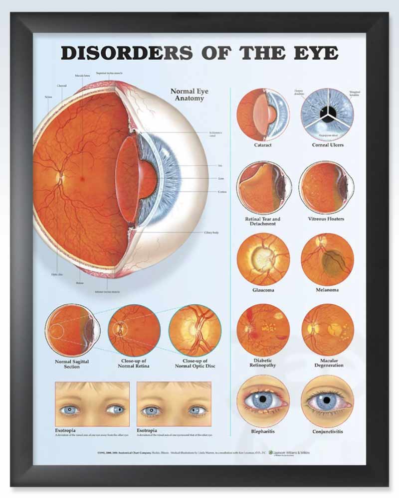 Human Eye Disoder Disorders of the Eye Exam Room Anatomy Posters – clinicalposters.com