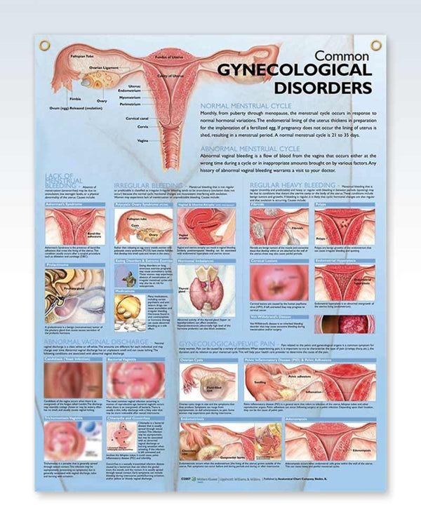 Laminated Gynecological Disorder Anatomy Posters | ClinicalPosters