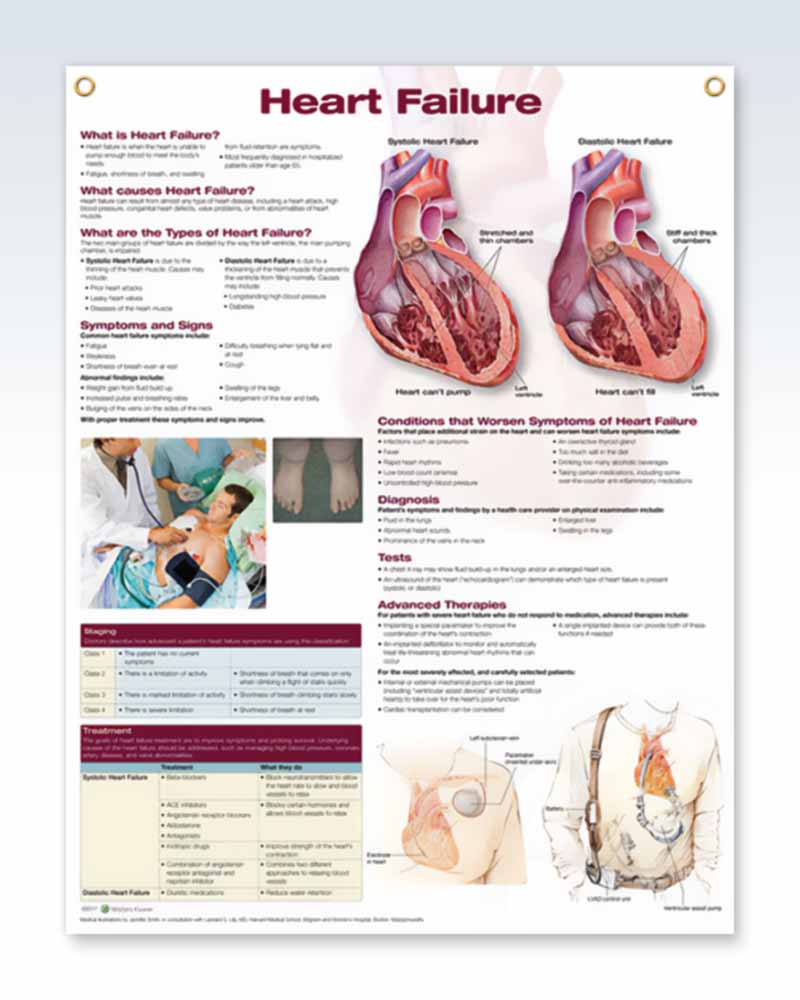 Heart Failure Exam Room Anatomy Posters – clinicalposters.com