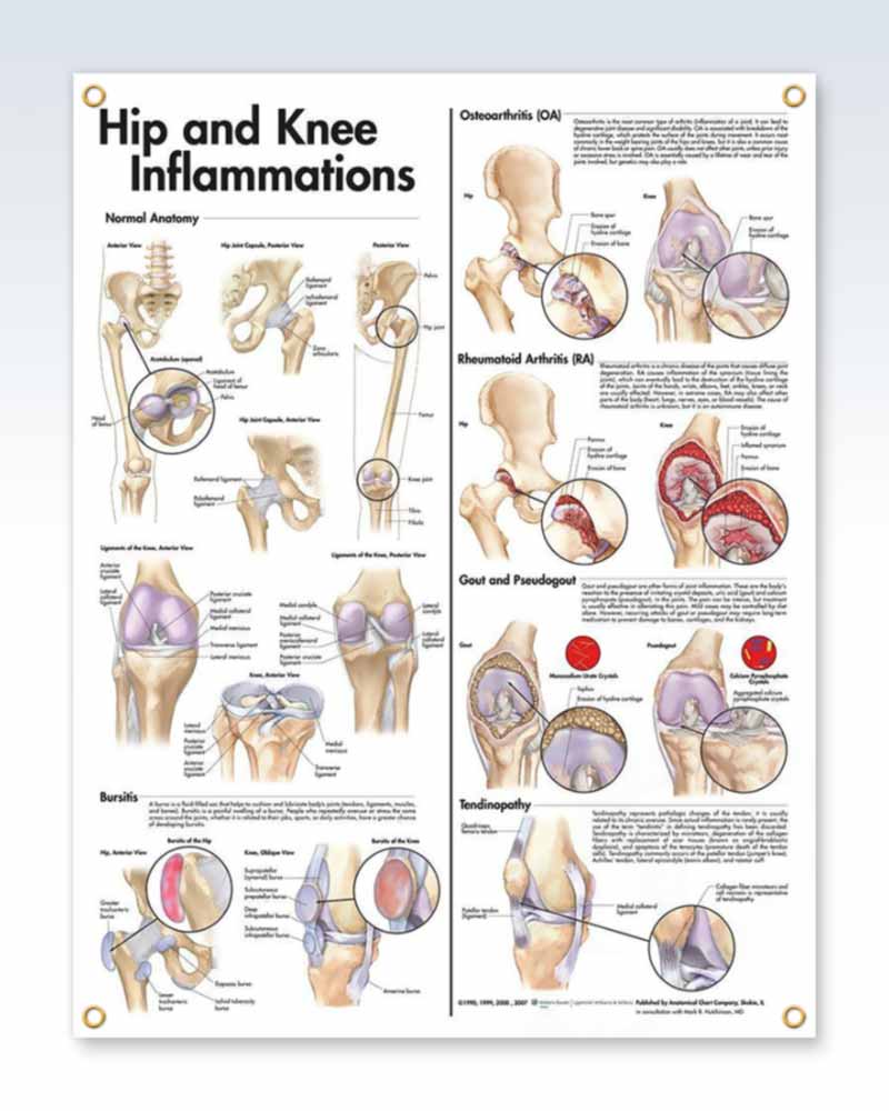 Hip and Knee Inflammations Laminated Anatomy Posters | ClinicalPosters