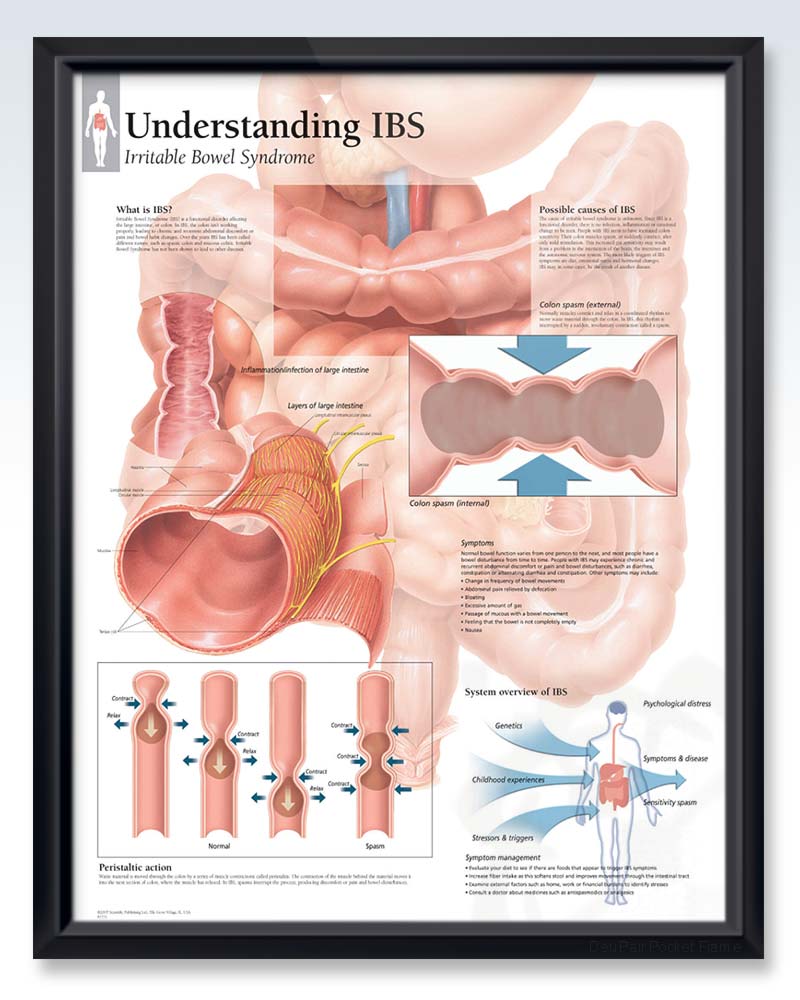 Understanding IBS Exam-Room Anatomy Posters | ClinicalPosters