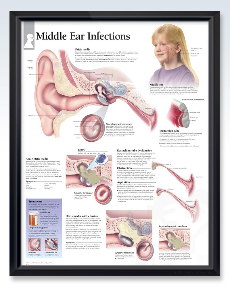 Middle Ear Infections Exam-Room Anatomy Poster | ClinicalPosters