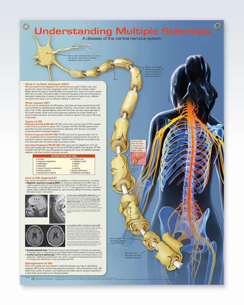Multiple Sclerosis Laminated Anatomy Poster Clinicalposters Com