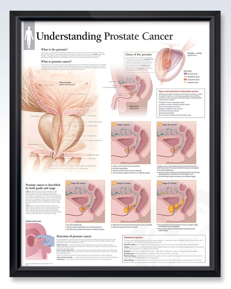 Prostate Cancer Exam-Room Anatomy Posters | ClinicalPosters