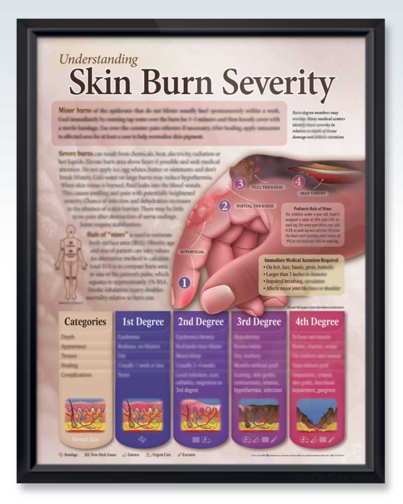 Skin Burn Severity ExamRoom Anatomy Posters