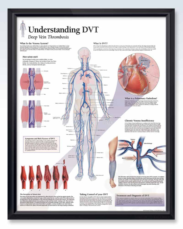 Understanding DVT Exam-Room Anatomy Poster | ClinicalPosters
